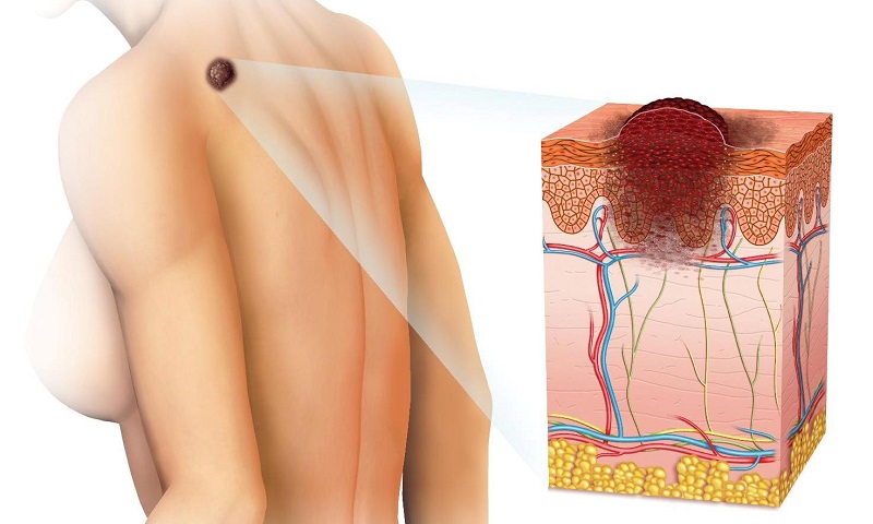 Обзорное фото рака кожи на спине