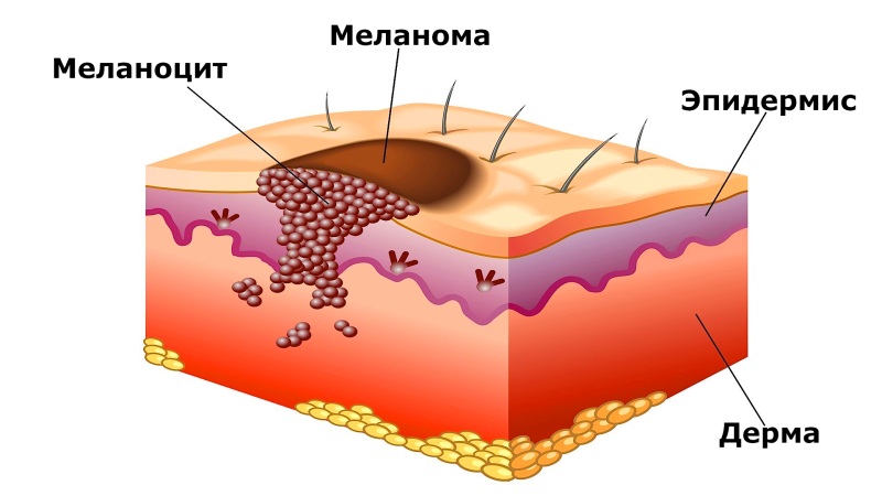 Описание составляющих меланомы