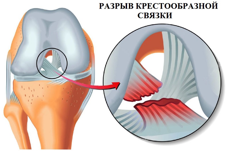 Разрыв крестообразной связки колена