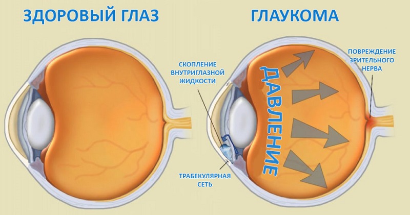 Здоровый глаз и глаукома