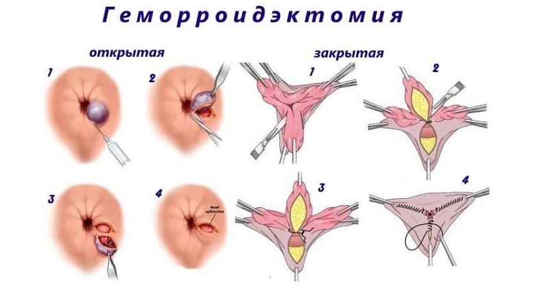 Геморроидектомия внешняя внутренняя