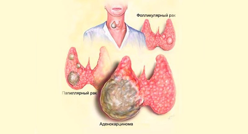 Виды рака щитовидной железы