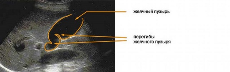 Перегиб желчного пузыря на рентгене