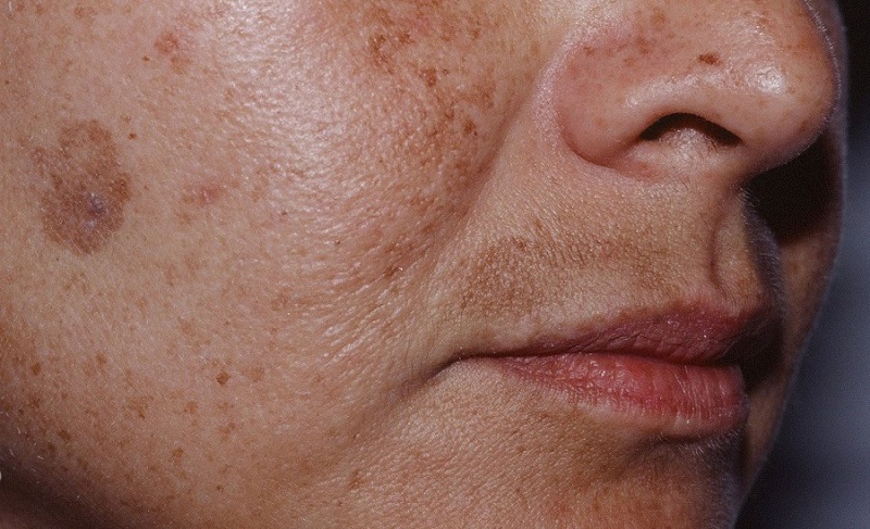 Пигментные пятна на лице у человека