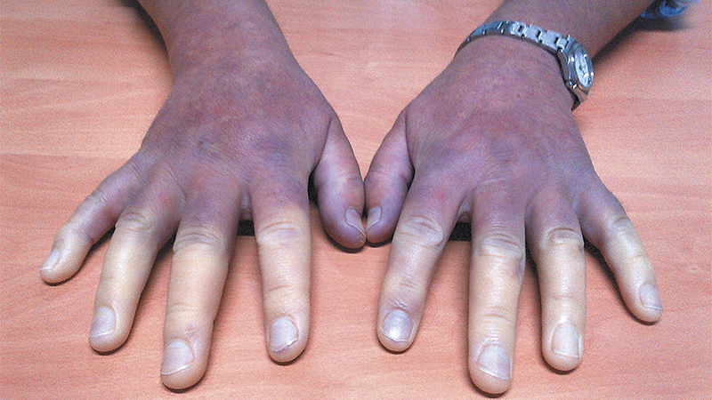 Поражения обоих рук при системной склеродермии