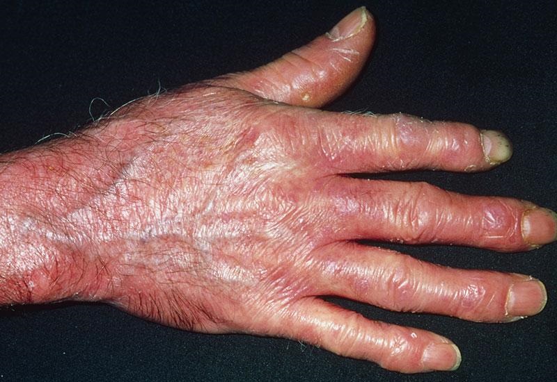 Вид рук при системной склеродермии
